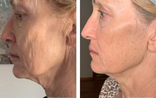 Before + After - Ageing Skin