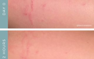 Before + After - Allergic Reaction + Eczema