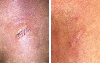 Before + After - Basal Cell Carcinoma Surgery