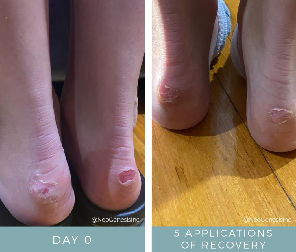 Before + After - Ballerina Blisters