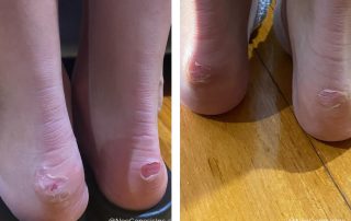 Before + After - Ballerina Blisters