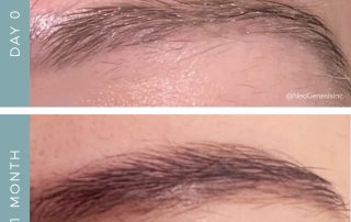 Before + After - Brow Loss