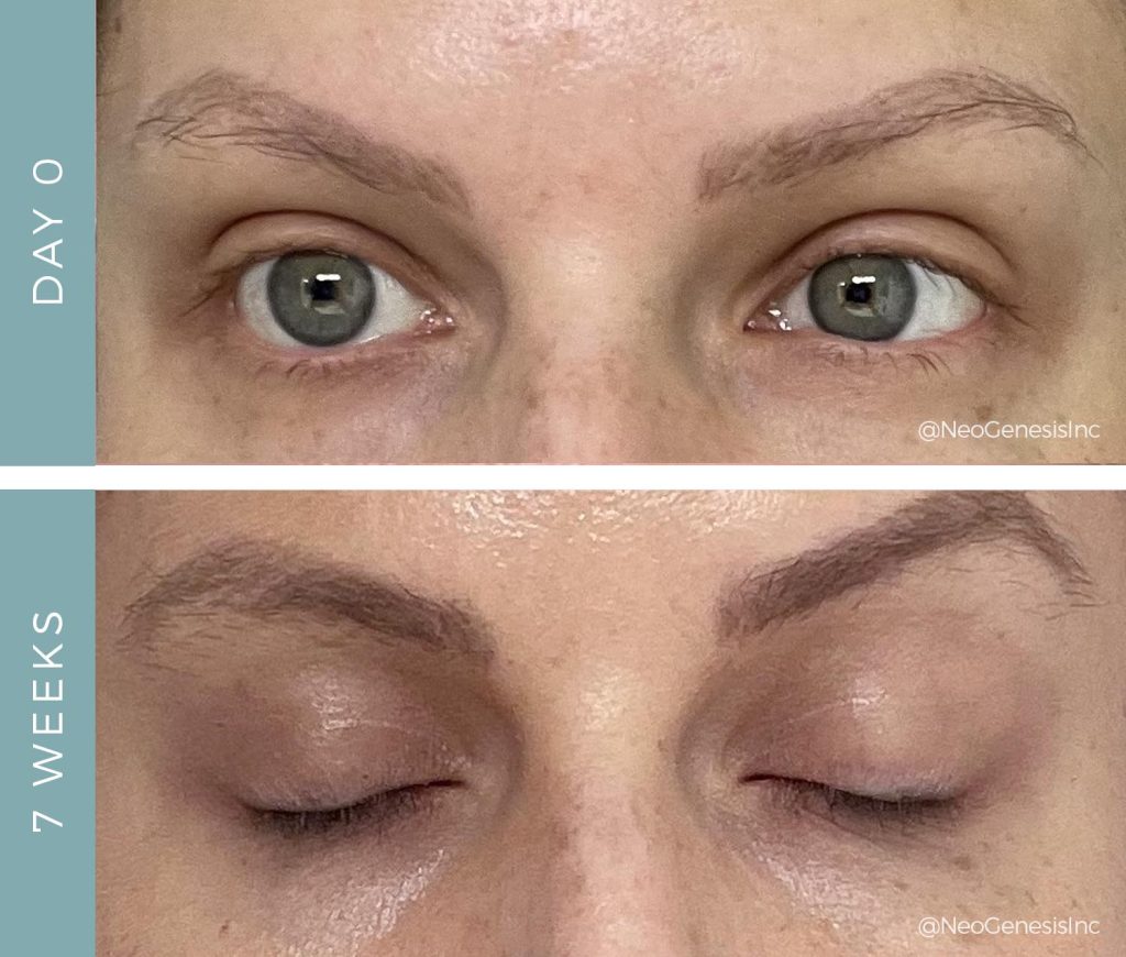 Before + After - Chemotherapy Brow + Lash Loss