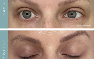 Before + After - Chemotherapy Brow + Lash Loss