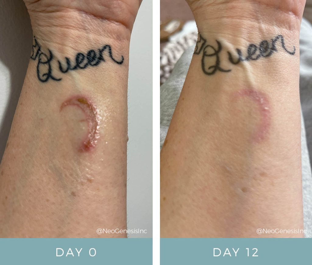 Before + After - Wound Care for Burn