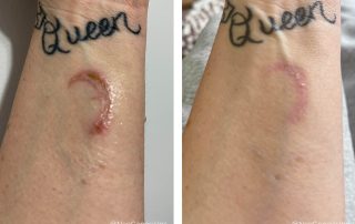 Before + After - Wound Care for Burn