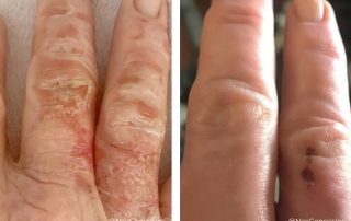 Before + After - Burns - Wound Care