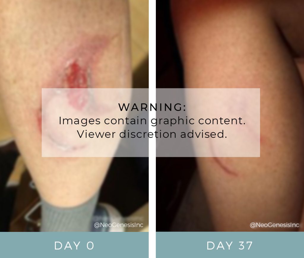 Before + After - Wound Care for Burns