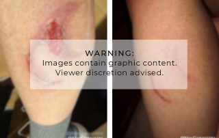 Before + After - Wound Care for Burns