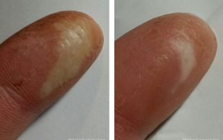 Before + After Wound Care - Mechanic Burn