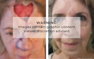 Before + After - Basal Cell Carcinoma Cancer Surgery