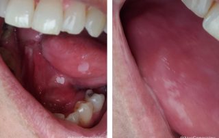 Before + After - Tongue Cancer Surgery