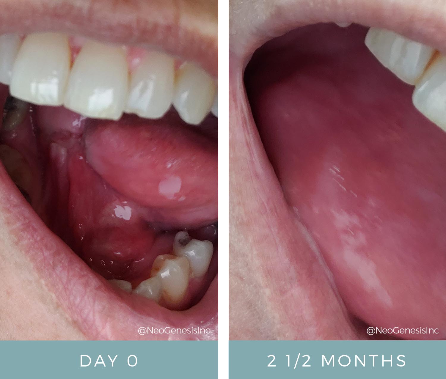 Before + After - Tongue Cancer Surgery