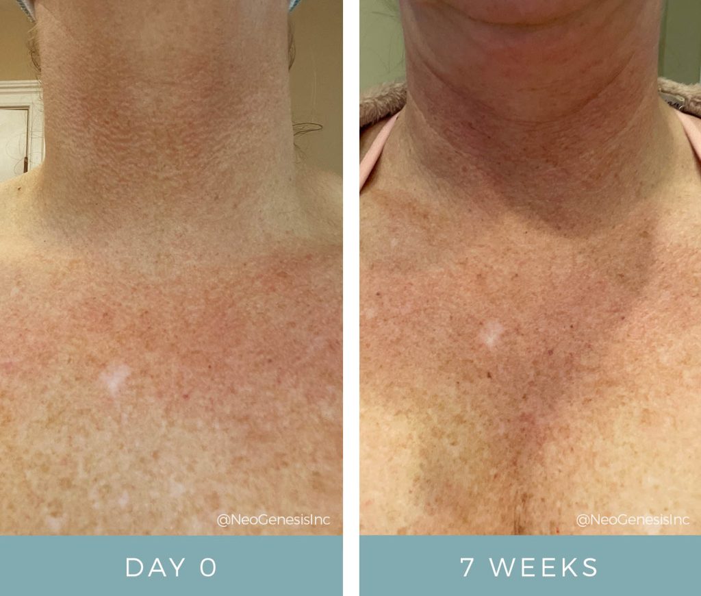 Before + After - Chemotherapy using NeoGenesis products