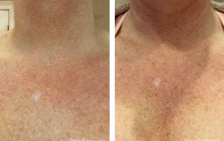 Before + After - Chemotherapy using NeoGenesis products