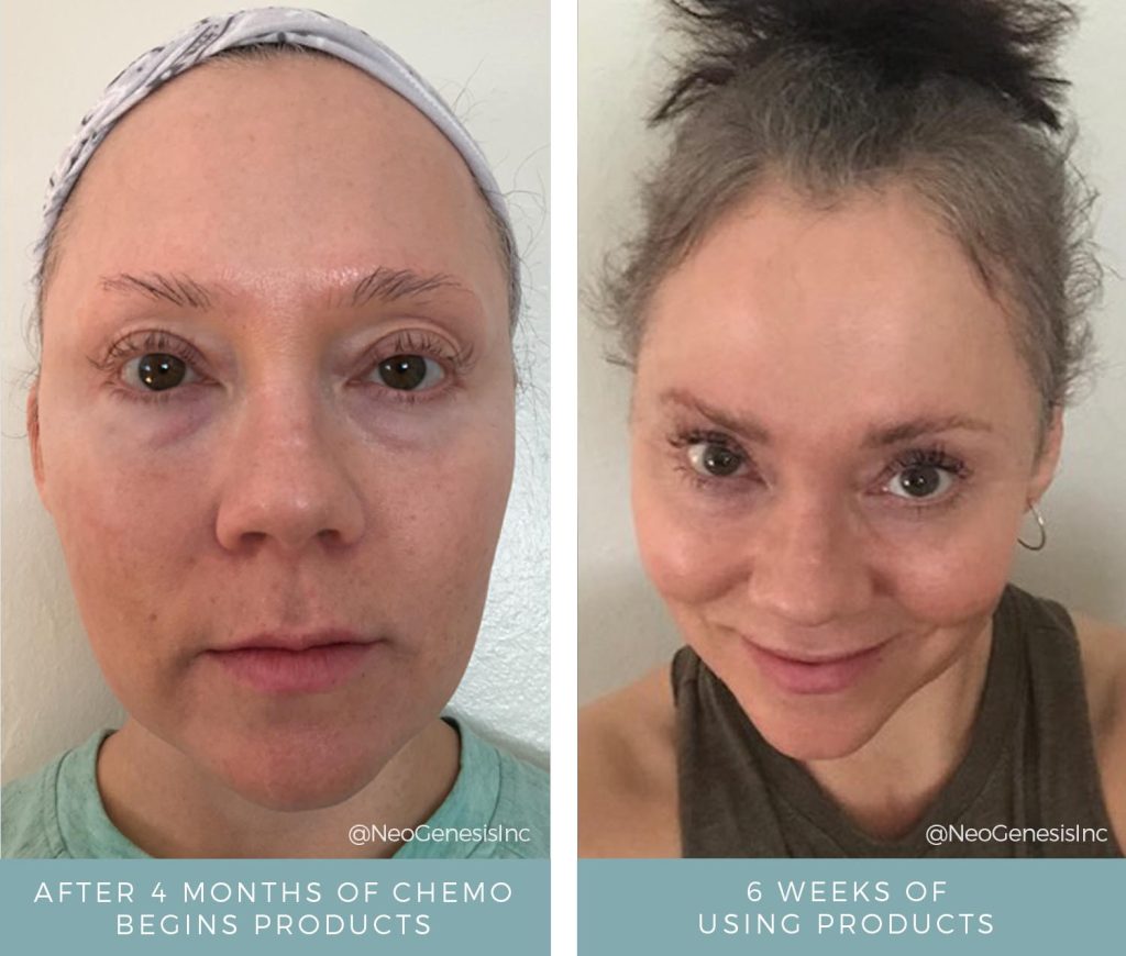 Chemotherapy - Hair + Lash + Brow Loss