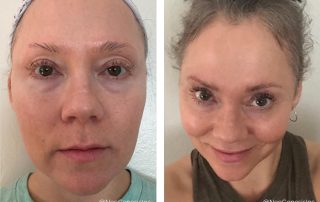 Chemotherapy - Hair + Lash + Brow Loss