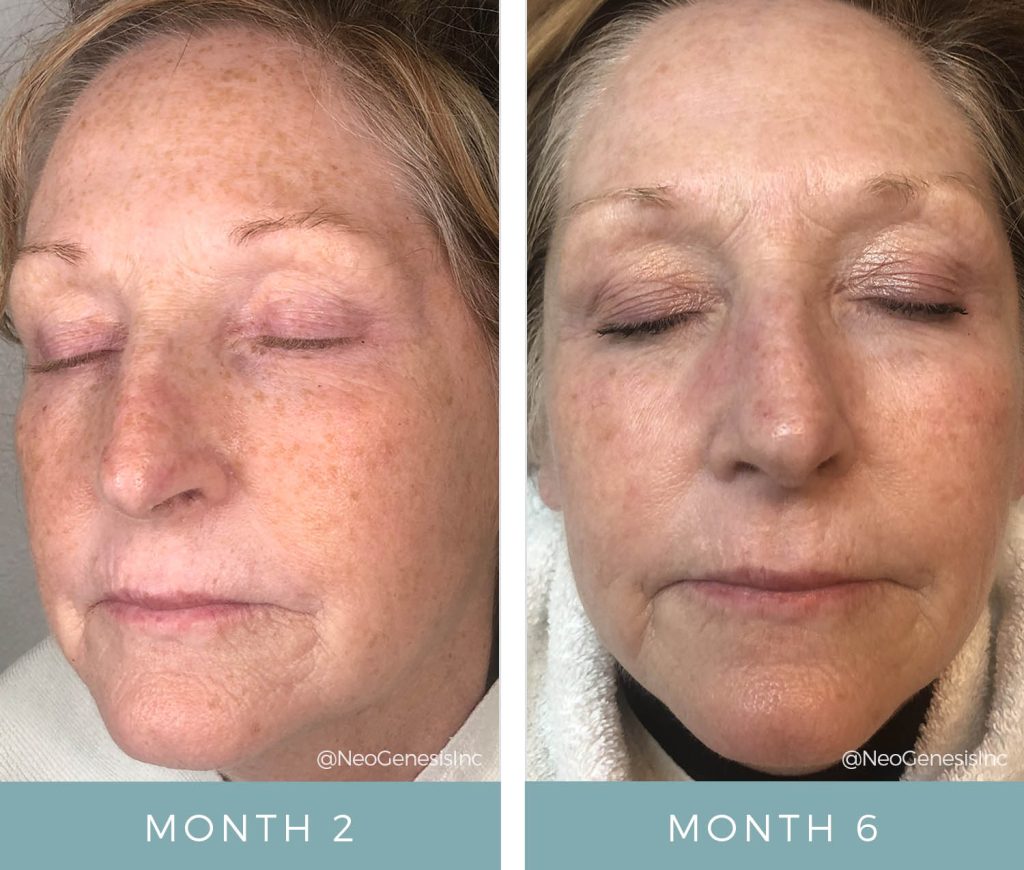 Before + After - Chemotherapy - Chronic Dry Skin