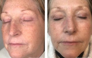 Before + After - Chemotherapy - Chronic Dry Skin