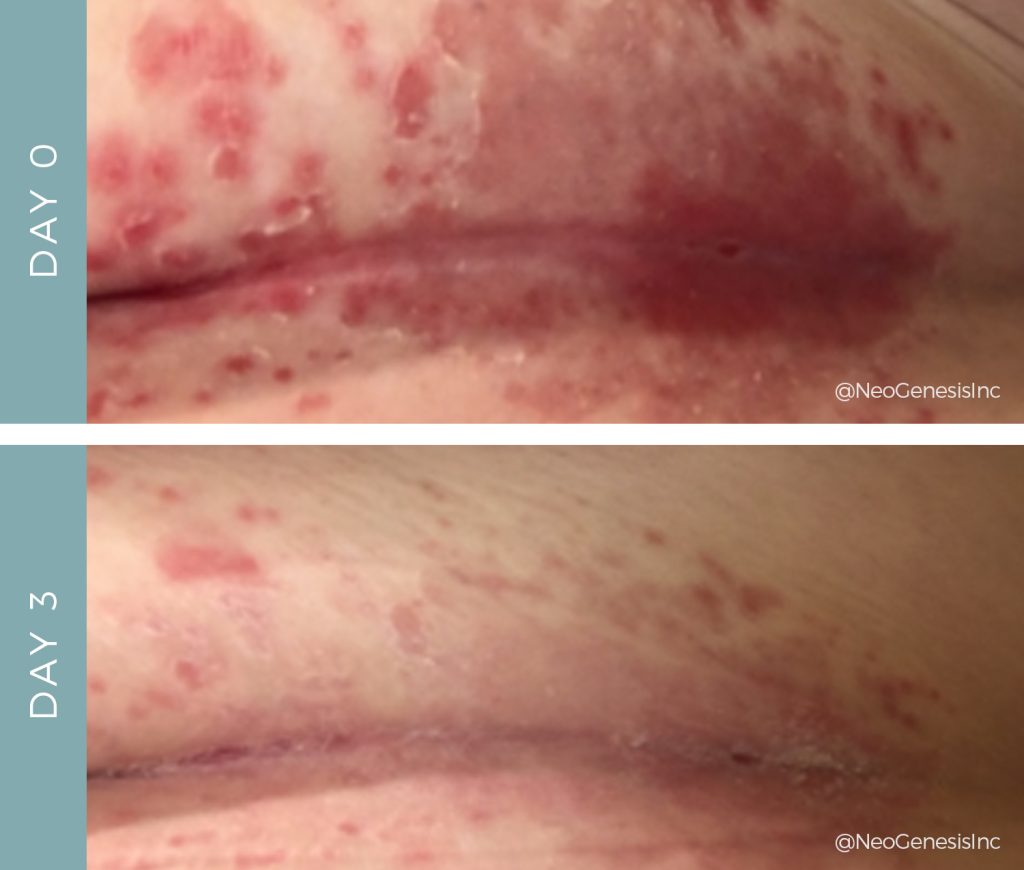 Before + After - Chemo Rash