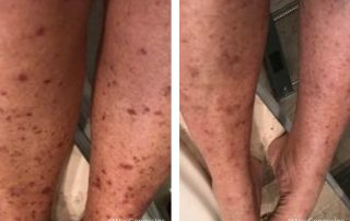 Before + After - Chemotherapy Rash