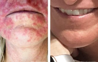 Before + After - Chemotherapy Scarring
