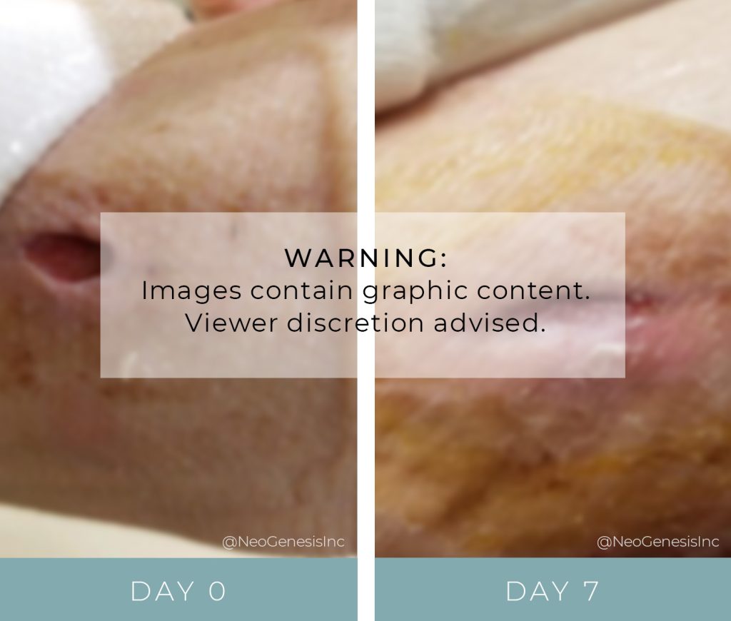 Before + After - Wound Care for Diabetic Ulcers