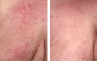 Before + After - Eczema