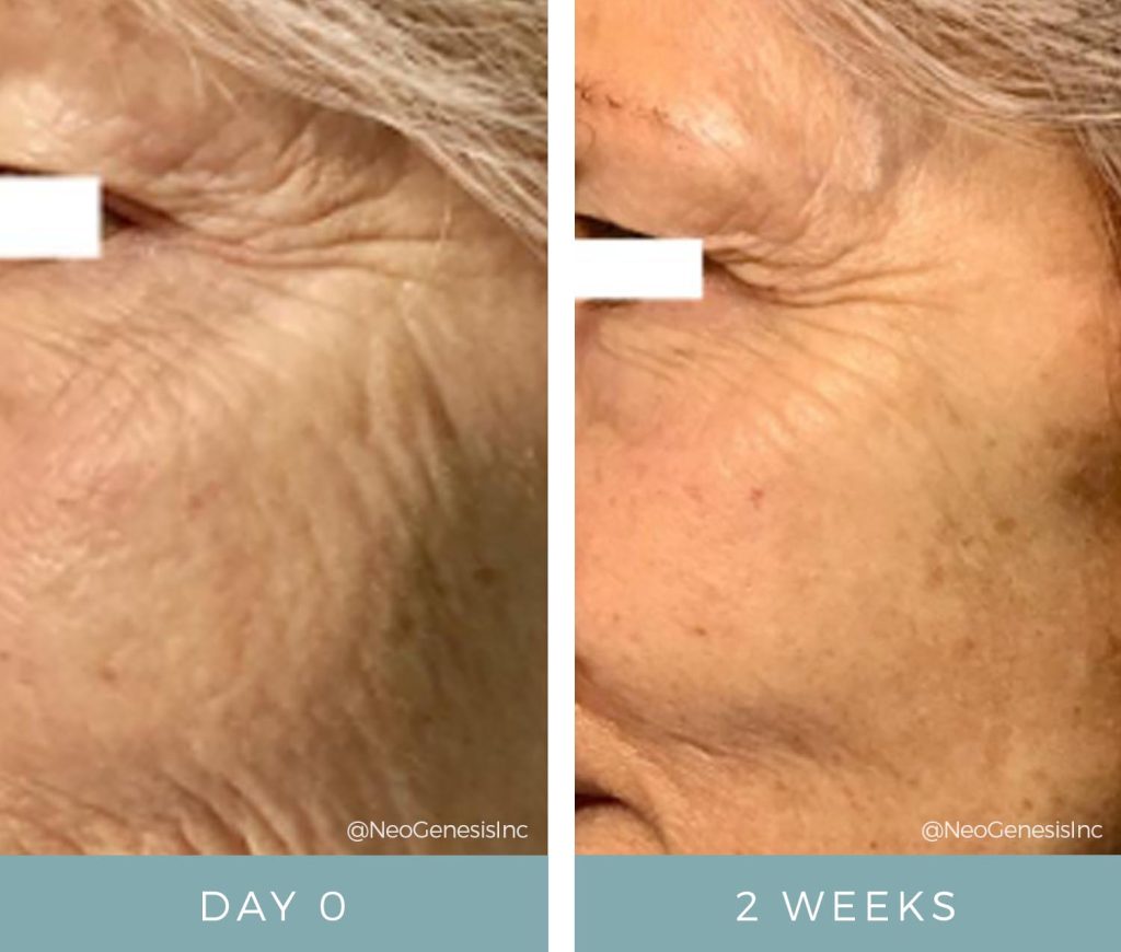 Before + After - Fibroblast Skin Tightening