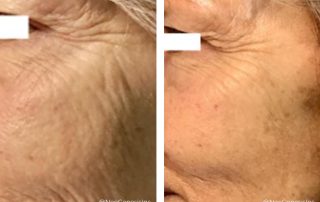 Before + After - Fibroblast Skin Tightening