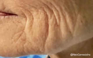 Before - Fibroblast