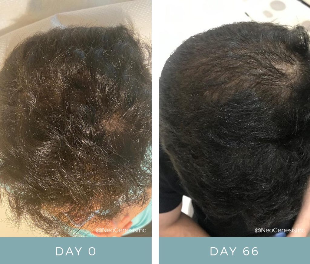 Before + After - Microneedling + Recovery Serum for Hair Loss