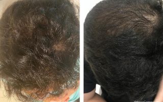 Before + After - Microneedling + Recovery Serum for Hair Loss