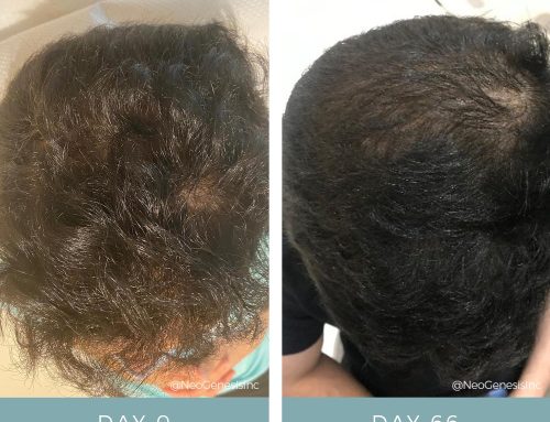 Hair Loss + Microneedling