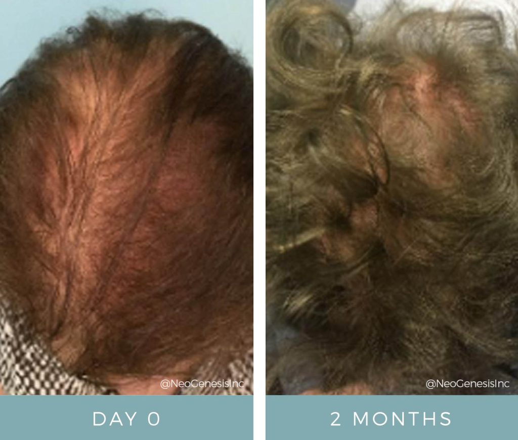 Before + After - Hair Loss + NeoGenesis Hair Thickening Serum