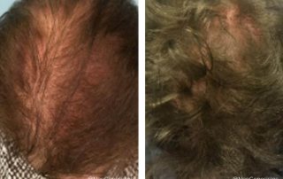 Before + After - Hair Loss + NeoGenesis Hair Thickening Serum