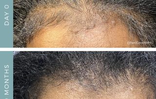 Before + After - Hair Loss