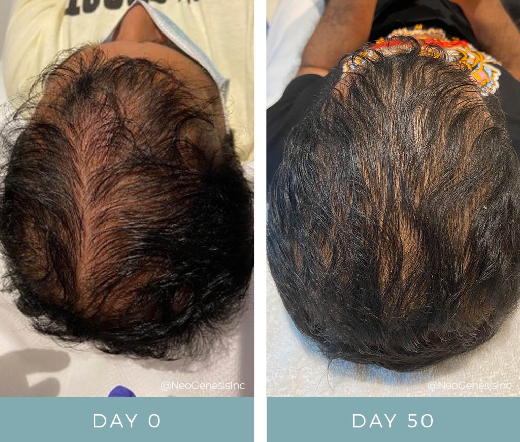 Before + After - Hair Loss + Microneedling