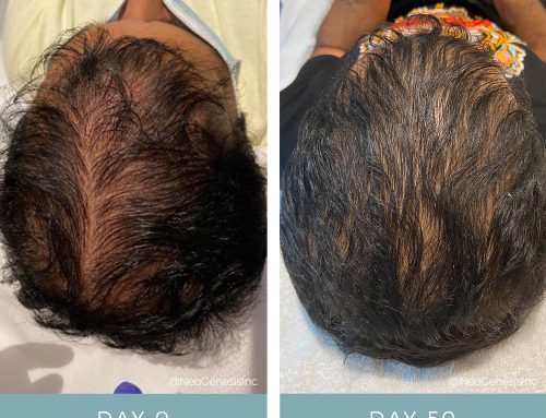 Hair Loss + Microneedling