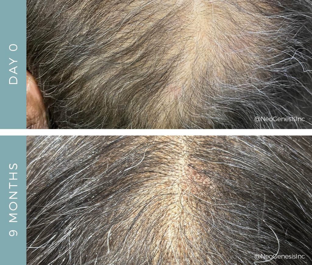 Before + After - Hair Loss