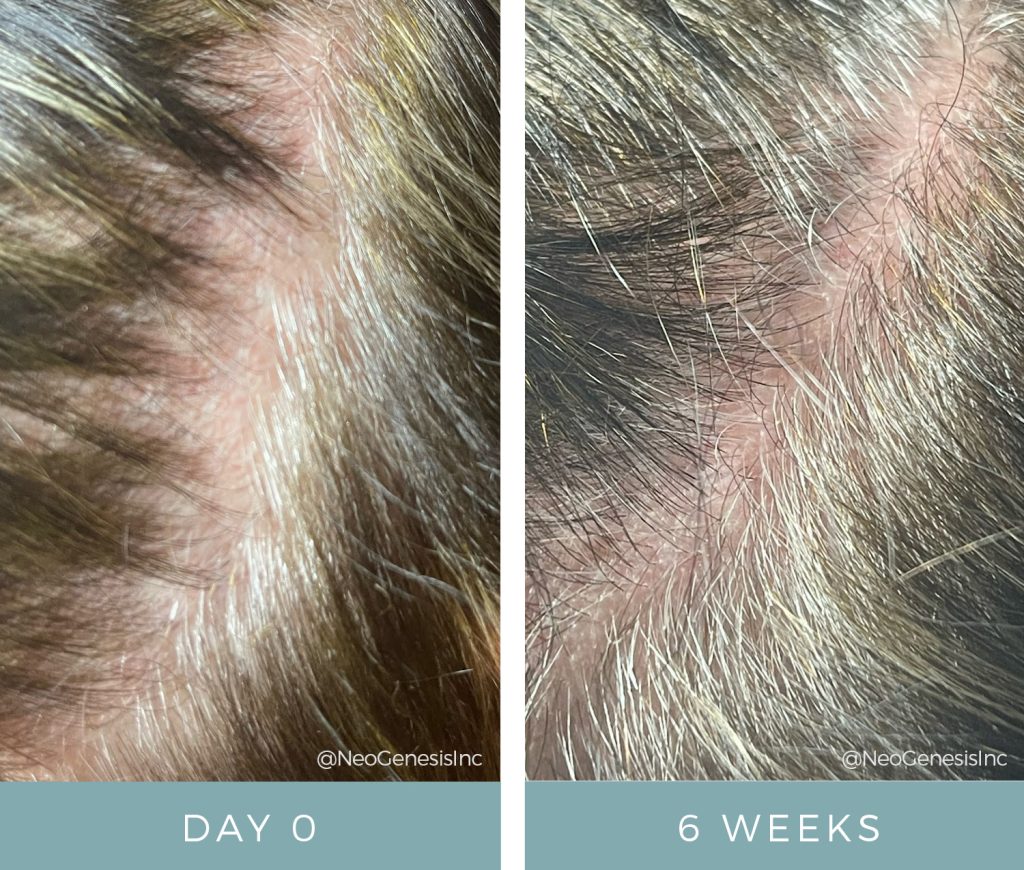 Before + After - Microchanneling for Hair Loss