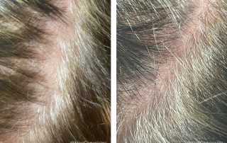 Before + After - Microchanneling for Hair Loss