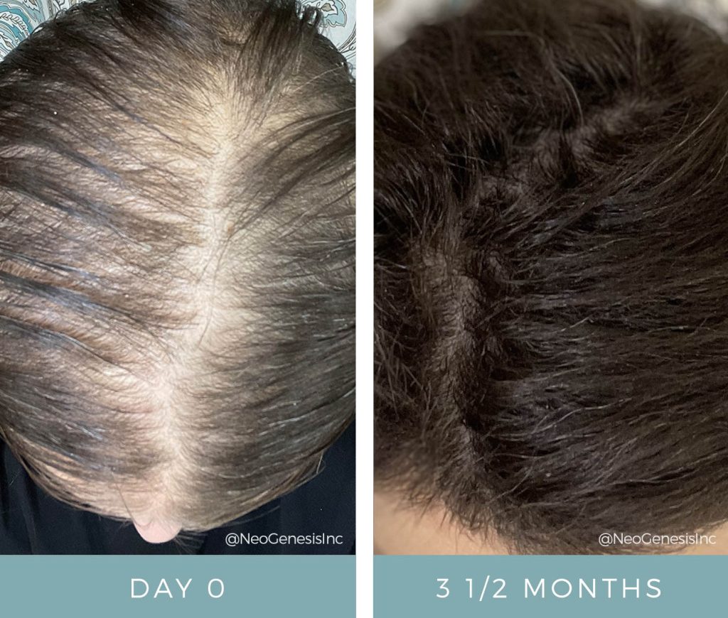 Before + After - Chemotherapy Hair Loss