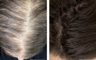 Before + After - Chemotherapy Hair Loss