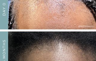 Before + After - Hair Loss - Traction Alopecia