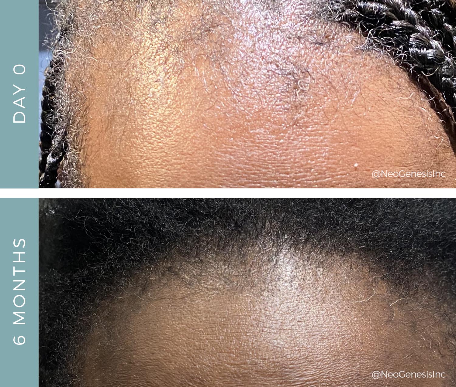 Before + After - Hair Loss - Traction Alopecia