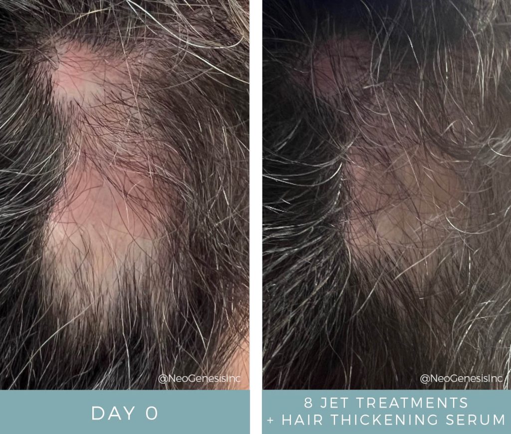 Before + After - Jet Plasma for Hair Loss