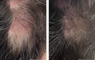 Before + After - Jet Plasma for Hair Loss