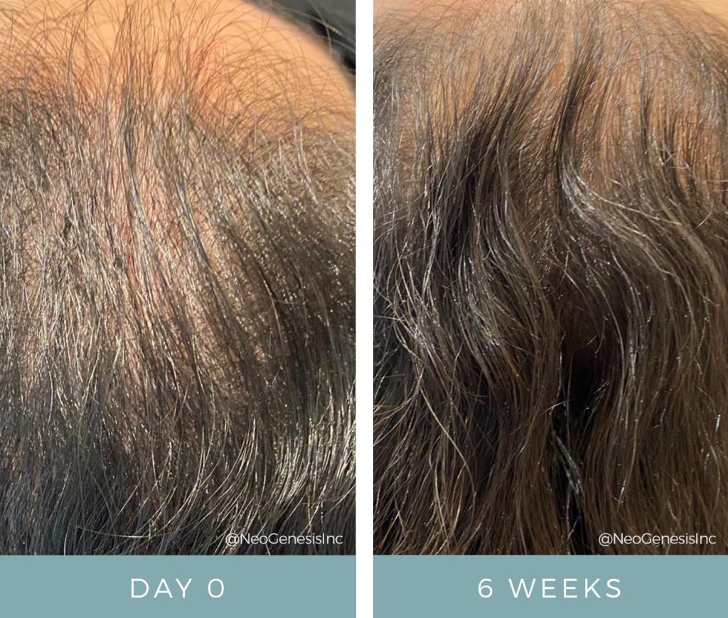 Before + After - Hair Loss + Microneedling Treatments