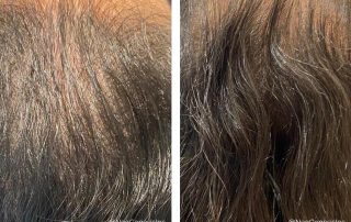 Before + After - Hair Loss + Microneedling Treatments